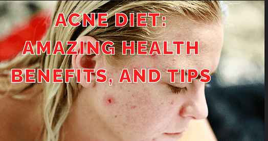 Acne is a common skin disorder that can afflict anyone at any age. It is distinguished by the appearance of pimples, blackheads, and whiteheads. While the precise etiology of acne is unknown, it is assumed to be a combination of genetics, hormones, and food. Acne is a lifestyle disease. This skin ailment is affecting about 10% of the global population. Acne is the most common dermatologic disorder in the United States, impacting about 17 million people of all ages. Partly it is because of fast food items, such as burgers, nuggets, hot dogs, French fries, drinks, and milkshakes, are cornerstones of a typical Western diet and may raise acne risk. acne diet...